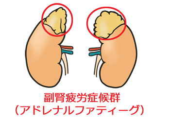 イライラしやすい腰痛 背中 持ちさんは副腎疲労じゃけぇ